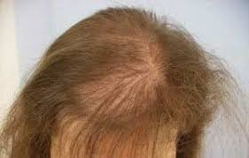 You may experience hair loss, or your hair may become brittle or coarse. Weight Loss And Hair Loss Weightlosslook