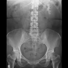 Nephrolithiasis Renal Medbullets Step 1