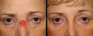 Skin cancer may initially appear as a nodule, rash or irregular patch on the surface of the skin. Skin Cancer Screening Treatment Reconstruction Facial Plastic Surgeon Gulf Shores Al