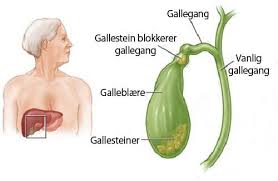 Gallesteiner dannes når gallen i galleblæren krystalliserer og blir til harde, steinlignende klumper. Hvordan Kan Jeg Vite Om Jeg Har Gallesteiner Veien Til Helse