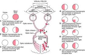 Types Of Anopsias Visual Field Defects And Corresponding