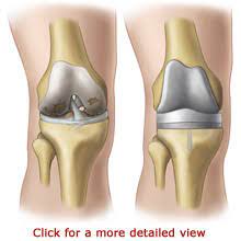 Minimally Invasive Knee Replacement Arthroplasty Gales Ferry Medical Patient Education