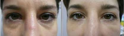 The amalian soft filler product line sf is characterized by a soft, fully hydrated texture, which can be injected easily and without resistance. Amalian Hyaluronic Acid Dermal Filler Information