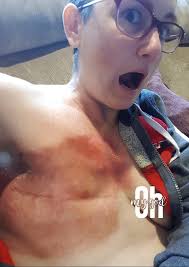 Healing from avulsion fracture