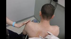 Image result for Scapulothoracic Injection