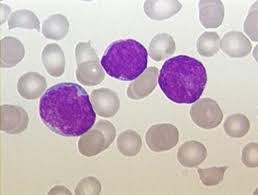 Akute Lymphatische Leukamie Wikipedia