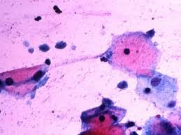 Image result for trichomonas images