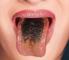 Image result for black hairy tongue symptoms