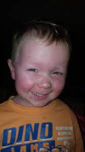 However, our faces still need sun protection, and sunscreen is known to run into eyes. Allergic Reaction To Sunscreen Toddler Life Babycenter Australia