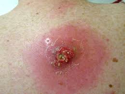 Image result for Skin Infection