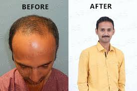 Hair restoration treatments at ak clinics, hyderabad. Services Hairsure Best Hair Transplant Clinic In Hyderabad From Hyderabad Telangana Id 4895058