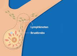 Chirurgische Therapie Bei Brustkrebs Mit Lymphknotenbefall