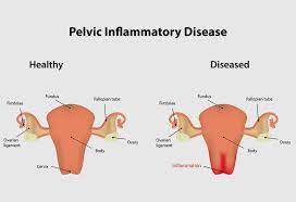 We did not find results for: Pelvic Inflammatory Diseases Pid Reasons Symptoms Treatment