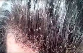 Check spelling or type a new query. This Video Of A Man S Disgusting Head Lice Infestation Will Make Your Skin Crawl Mirror Online