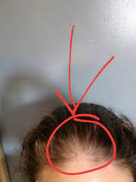 Androgenic alopecia (aa) is one of the most prevalent aesthetic concerns, affecting an estimated 30% of men over the age of 40. What Causes This Sort If Hair Loss In A 29 Yr Old Female Femalehairloss