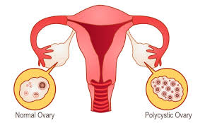 Burst cysts, which are also unusual, can cause intense pain and internal bleeding. Why Ovarian Cysts Are A Cause For Concern Health Plus