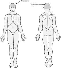 Cervicogenic Headache Musculoskeletal Key