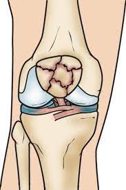 The knee is the largest joint in the body. Common Knee Injuries Orthoinfo Aaos
