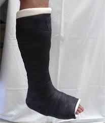 Image result for Short Leg Cast