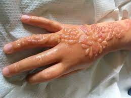 Dan juga henna ini tidak akan merubah muka kalian terlihat menor sebab henna tentupasti saja mencocokan warna kulit anda maka tak bisa yang namanya belang antara wajah dan leher. Bahaya Henna Hati Hati Pakai Henna Tangan Anak Ini Melepuh