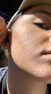 It is the most common skin problem in the united states. Is This Fungal Acne I Tried Washing My Face Nizoral Shampoo For A Week And No Results Help Fungalacne