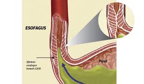 Pedih ulu hati merupakan rasa sakit di bahagian atas perut atau dada dan kadangkala sehingga ke bahagian kerongkong. Pedih Ulu Hati Punca Gastrik Ubat Gastrik Terbaik