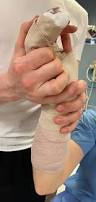 Image result for Ulnar Gutter Splint