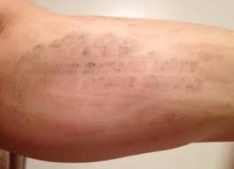 Maybe you would like to learn more about one of these? Complete Inner Bicep Tattoo Removal Review Realself