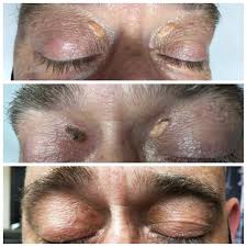 Image result for xantelasma