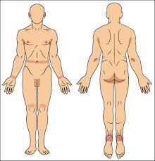 Image result for scabies in the groin area