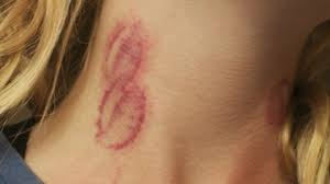 Berikut cara hilangkan jerawat blackhead dan whitehead secara alami yang harus anda ketahui. Cara Hilangkan Love Bites