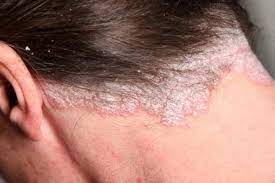 Anda bisa memanfaatkannya untuk membuat situs web anda sendiri dengan. Ini Perbedaan Antara Eczema Dan Psoriasis Womantalk