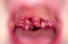 Image result for Tonsillitis