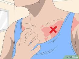 See full list on wikihow.com 3 Ways To Treat Peeling Sunburns Wikihow