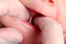 In this procedure, doctors cut the short, tight frenulum piece. Tongue Tie And Infant Feeding On Line Course Sarah Oakley Lactation