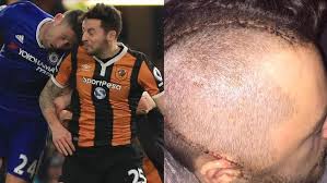 It is with deep regret that the club has to announce that, following the head injury suffered on 22nd january 2017, ryan mason is. Ryan Mason Retires Due To Skull Fracture Hull City England Midfielder Retires Aged 26 The Advertiser