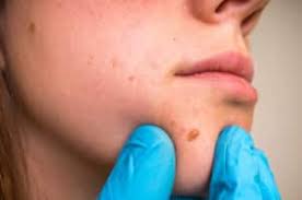 Image result for skin cancer on nose pimple