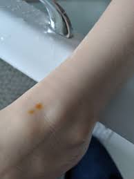 Woke up this morning with some rust colored splotches (not really spots) on both palms of my hands. Rust Coloured Spots On 4 Year Old Mumsnet