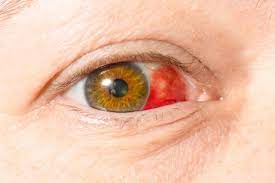 Bluterguss Im Auge Ursachen Und Gegenmassnahmen Heilpraxis