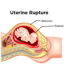 The film is about a child neglect and a corruption of the belief —motherhood exists in all female— in japan. What Is Uterine Rupture Causes Symptoms And Treatment