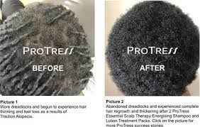 Food and drug administration, or fda, has approved a number of prescription medications for use in combating hair loss. Causes Of Hair Loss For Black Men Protress Hair Care