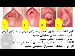مهم جدا بعض أنواع غشاء البكارة بالصور الحقيقية من غوغل أرجو التركيز بين ما هو مكتوب و بين الصور Youtube