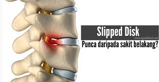 Kecederaan yang kekal pada saraf. Masalah Slipped Disk Berpunca Sakit Belakang Azeniahmad Com