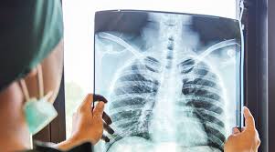 Zaturre Pnomoni Nedenleri Belirtileri Ve Tedavisi Yeditepe Universitesi Hastanesi