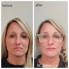 I'm back! I've been busy doing what I love. Helping my patients' health and  wellness. Part of that involves helping them look & feel better. Check out  this one small change. Lip
