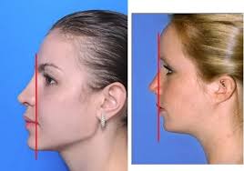 notice how the woman on the left has a very forward mandible and her lips and nose project outwards much more also her brow in 2021 cheekbones nose shapes face skin