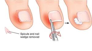 Image result for Toenail Removal