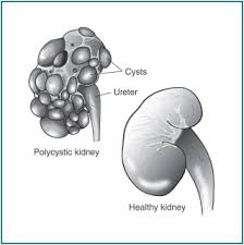 Medications included antibiotics in 100%, hydroxychloroquine in 96. Polycystic Kidney Disease Pkd Symptoms Treatments Causes American Kidney Fund Akf