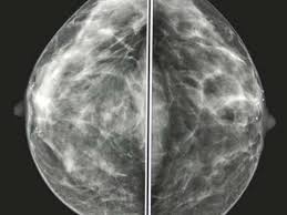 Corrine describes the egg box of lemons as a playful, friendly image which might help women overcome their fear of the disease. What Does Breast Cancer Feel Like Lasopamin