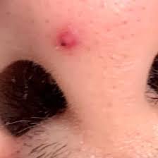 Dabei fühlte ich ein ziemlich warmes, wie fließendes gefühl. Kleinen Pickel An Der Nase Ausgedruckt Gesundheit Und Medizin Gesundheit Blutvergiftung